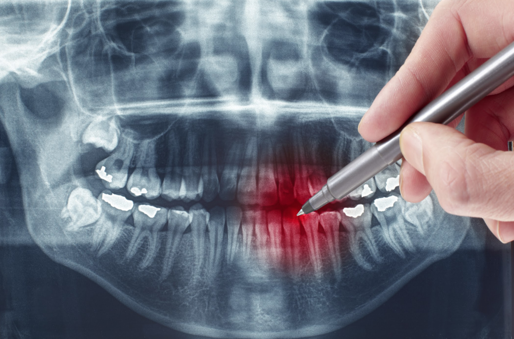 root canal benefits